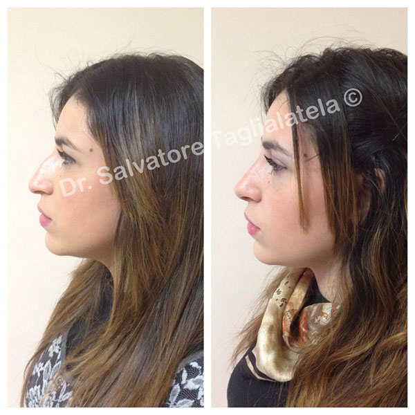 Rinoplastica dr Taglialatela