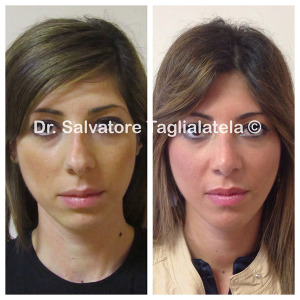 Intervento rinoplastica dr Taglialatela