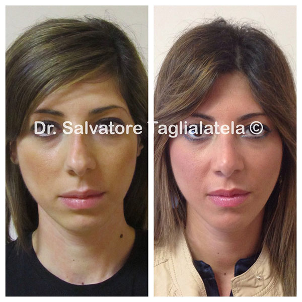 Intervento rinoplastica dr Taglialatela