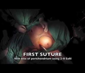 GoPro Breast Augmentation (Dr. Salvatore Taglialatela)