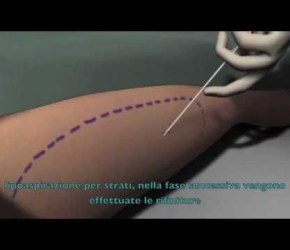 ANIMAZIONE 3D LIPOSUZIONE e LIPOSCULTURA (Napoli)