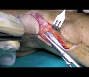 ASPORTAZIONE CISTI TENDINEA - GANGLION CYST REMOVAL (Chirurgia Plastica)