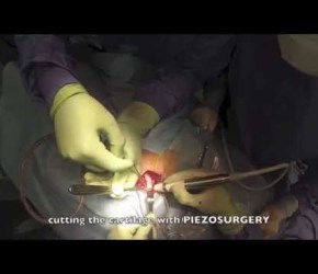 Harvesting Rib Cartilage (dr. Salvatore Taglialatela)