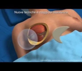 Ricostruzione del seno post-tumorale, sintesi delle tecniche (dr. Salvatore Taglialatela)