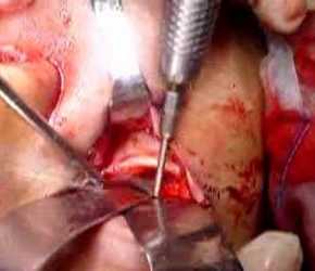 Osteotomy of the orbital floor