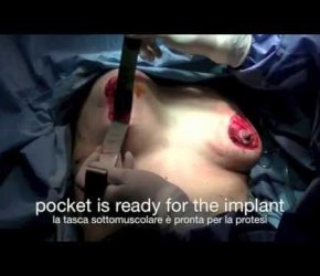 Round-Block Augmentation Mastopexy (dr. Salvatore Taglialatela)