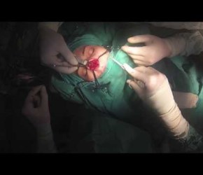 GoPro OPEN SEPTORHINOPLASTY (dr. Salvatore Taglialatela)