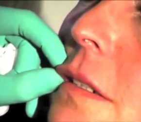 RIEMPIMENTO DELLE LABBRA con FILLER di ACIDO IALURONICO (Napoli)