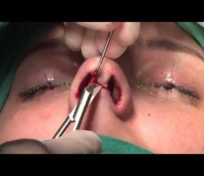 ULTRAFAST OPEN RHINOPLASTY (HD video)