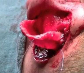 MODIFIED CHONGCHET OTOPLASTY (CHIRURGIA ESTETICA Dr. Taglialatela)