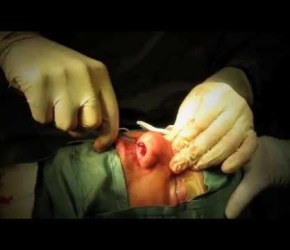 RINOPLASTICA APERTA / OPEN RHINOPLASTY (VIDEO INTERVENTO; Chirurgia Plastica NAPOLI)