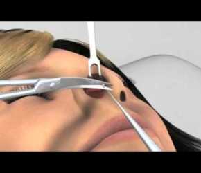 RINOPLASTICA a Napoli: ANIMAZIONE 3D (Dr. Salvatore Taglialatela)