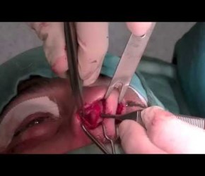 CLOSED RHINOPLASTY by dr. Salvatore Taglialatela (chirurgia plastica a Napoli)