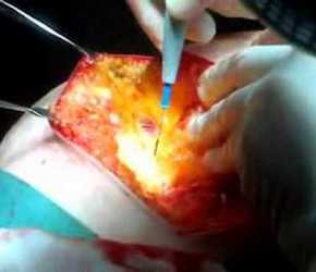 Gluteal perforator flap for breast reconstruction